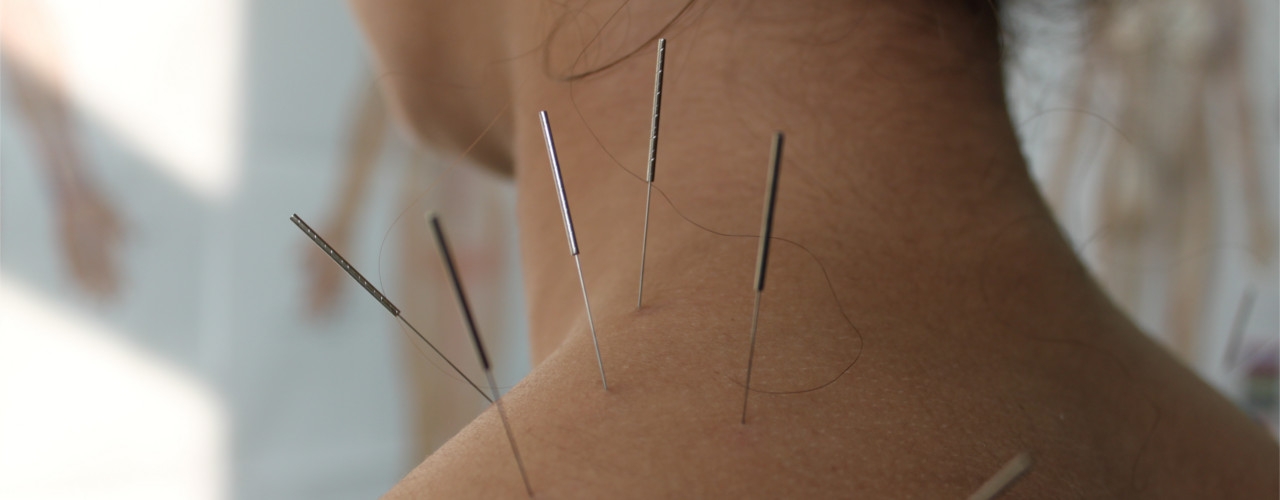 Acupuncture-MSK-Centre-Waterloo-ON