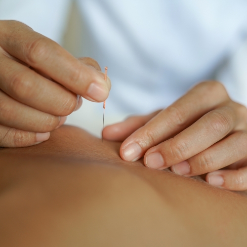 Dry-Needling-MSK-Centre-Waterloo-ON