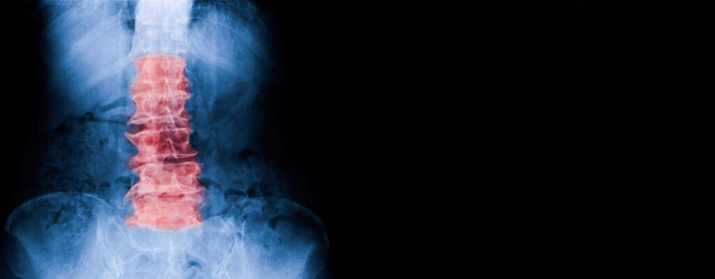 How Physiotherapy Can Help Manage Degenerative Back Conditions